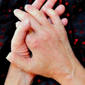 Scleroderma Scleroderma treatment in mumbai