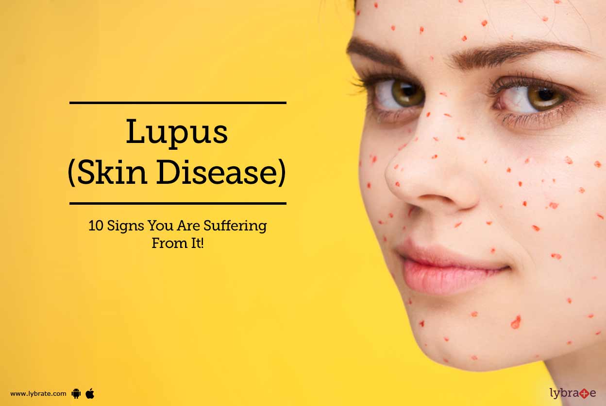 Lupus/SLE Treatment in Mumbai